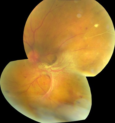 This image shows a fibrovascular membrane near the optic disc causing tractional retinal detachment and vision loss.