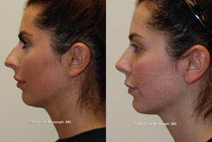 Rhinoplasty Specialist, Eric M. Joseph, M.D., Offers Nose Job Surgery Tips