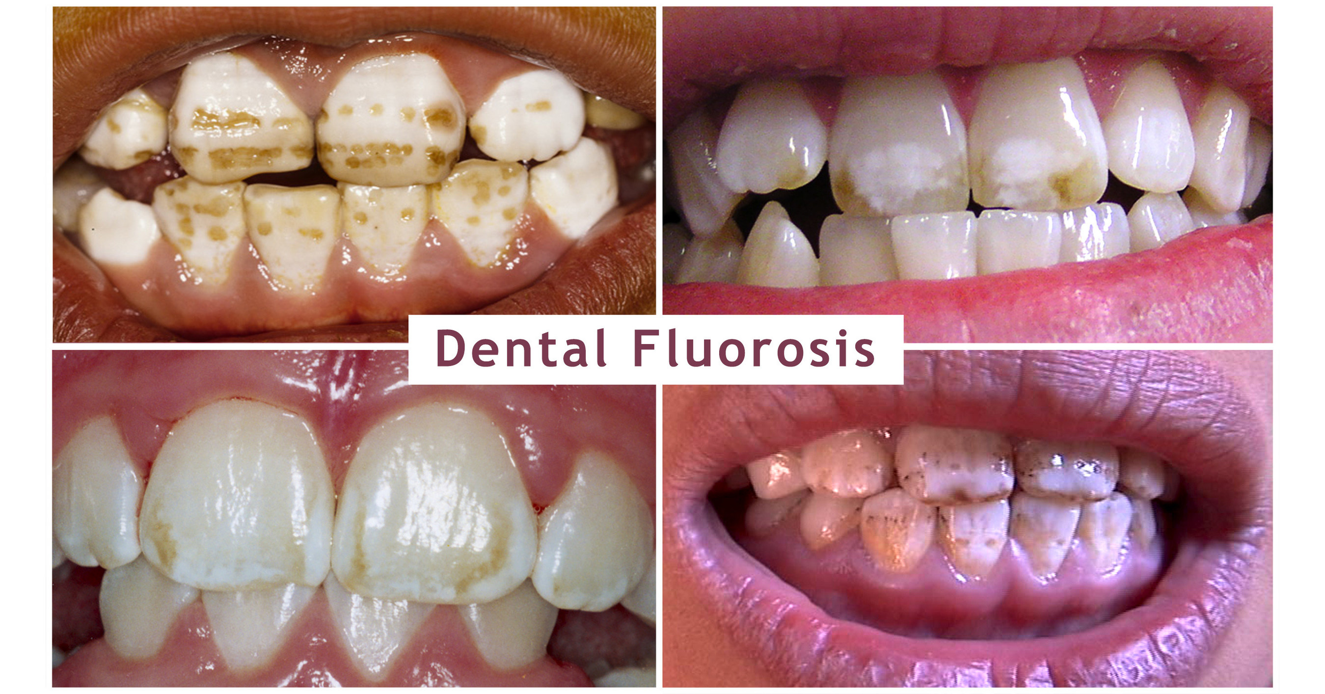 Fluoride Warnings Issued by International Group of Dentists