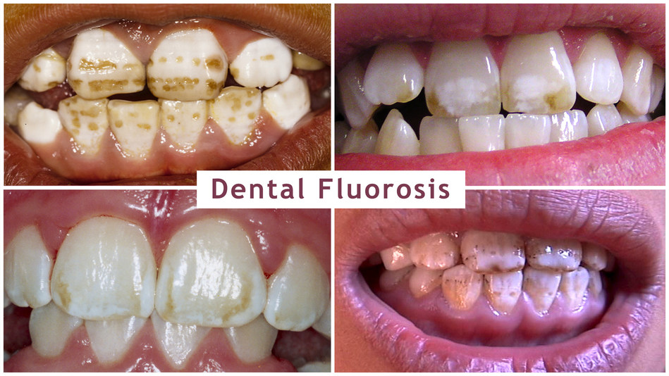 Dental fluorosis is a sign of fluoride toxicity and can range from very mild to severe. This photo is from Dr. David Kennedy of the International Academy of Oral Medicine and Toxicology (IAOMT) and is used with permission from victims of dental fluorosis.