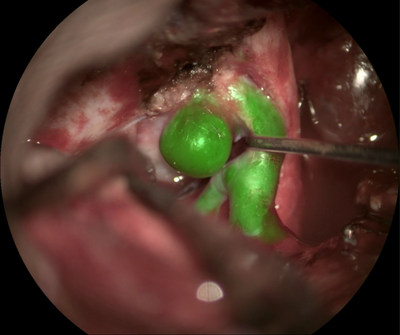 GLOW800 augmented reality fluorescence integrated with a M530 OH6 neurosurgical microscope. Photo courtesy of Cleopatra Charalampaki, MD, PhD, Professor of Neurosurgery, Department of Neurosurgery, Cologne Medical Center, Germany.