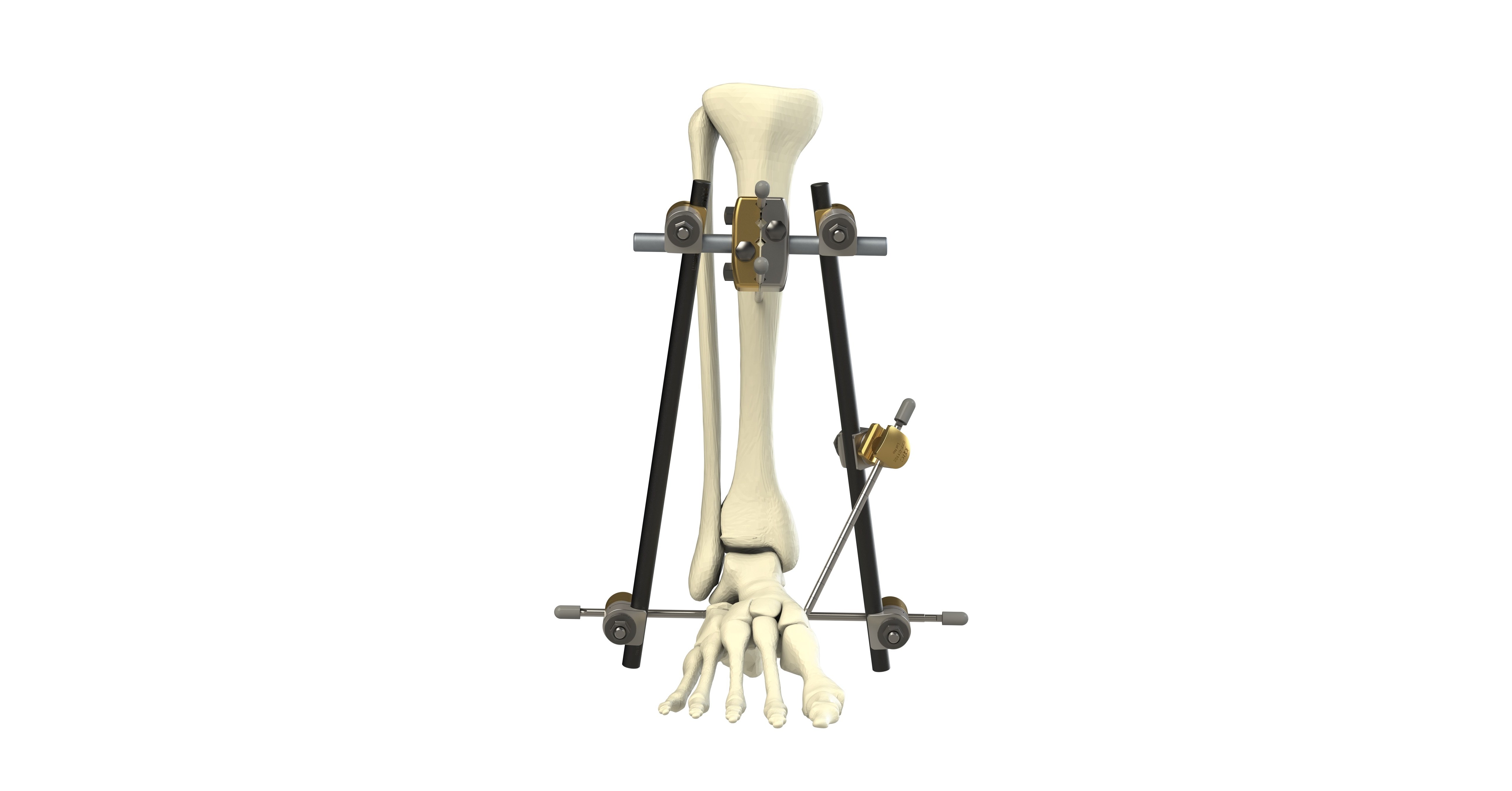 The Orthopaedic Implant Company Releases HighValue External Fixation