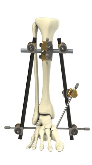 The Orthopaedic Implant Company Releases High-Value External Fixation System