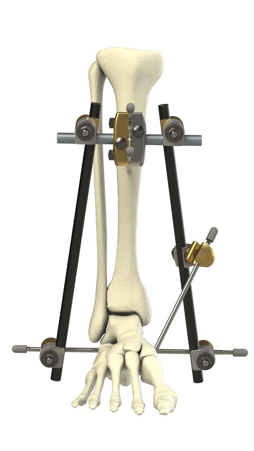 The Orthopaedic Implant Company Releases HighValue External Fixation