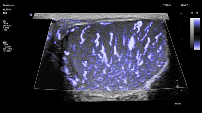Testicular ultrasound is one application of small parts imaging, a rapidly growing segment of ultrasound assessment, which allows clinicians to carefully examine organs close to the skin.  This image demonstrates Philips’ new MicroFlow Imaging that reveals remarkable sensitivity to small vessel blood flow.