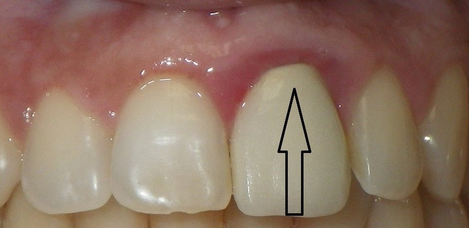 Stainless Steel Crown Technique For A Primary Molar Tooth Youtube