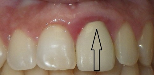 Dental Crowns Carry Health Risks Including Gum Disease And Increased Risk Of Root Canals