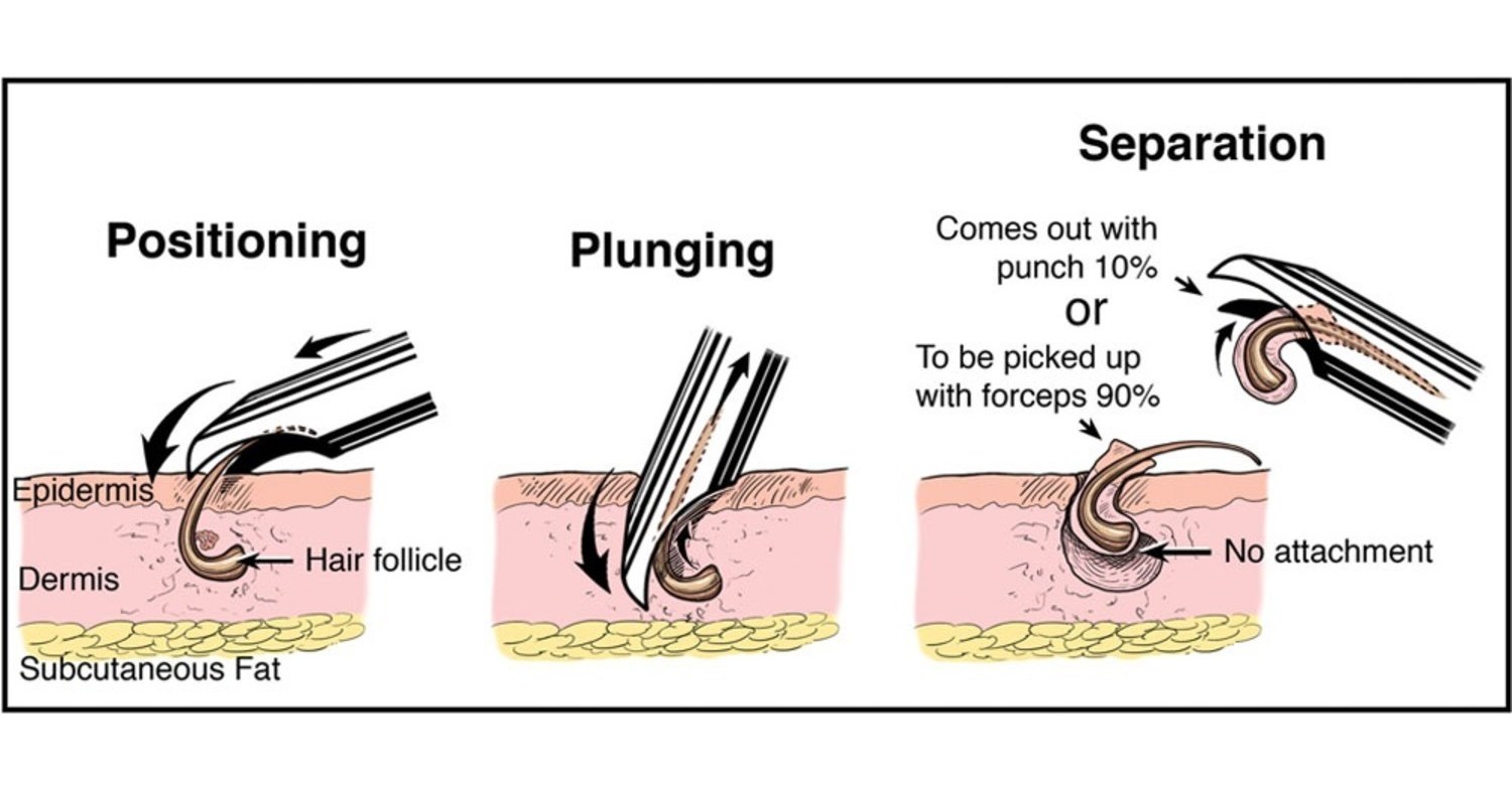 Groundbreaking New Hair Transplant Technology UGraft Debuts at the