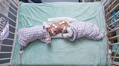 Formerly Conjoined Twins, Erin and Abby Delaney, Thriving Months After Separation Surgery at Children’s Hospital of Philadelphia