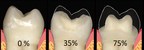 Studies Show That Dental Crowns Increase Risk of Root Canal