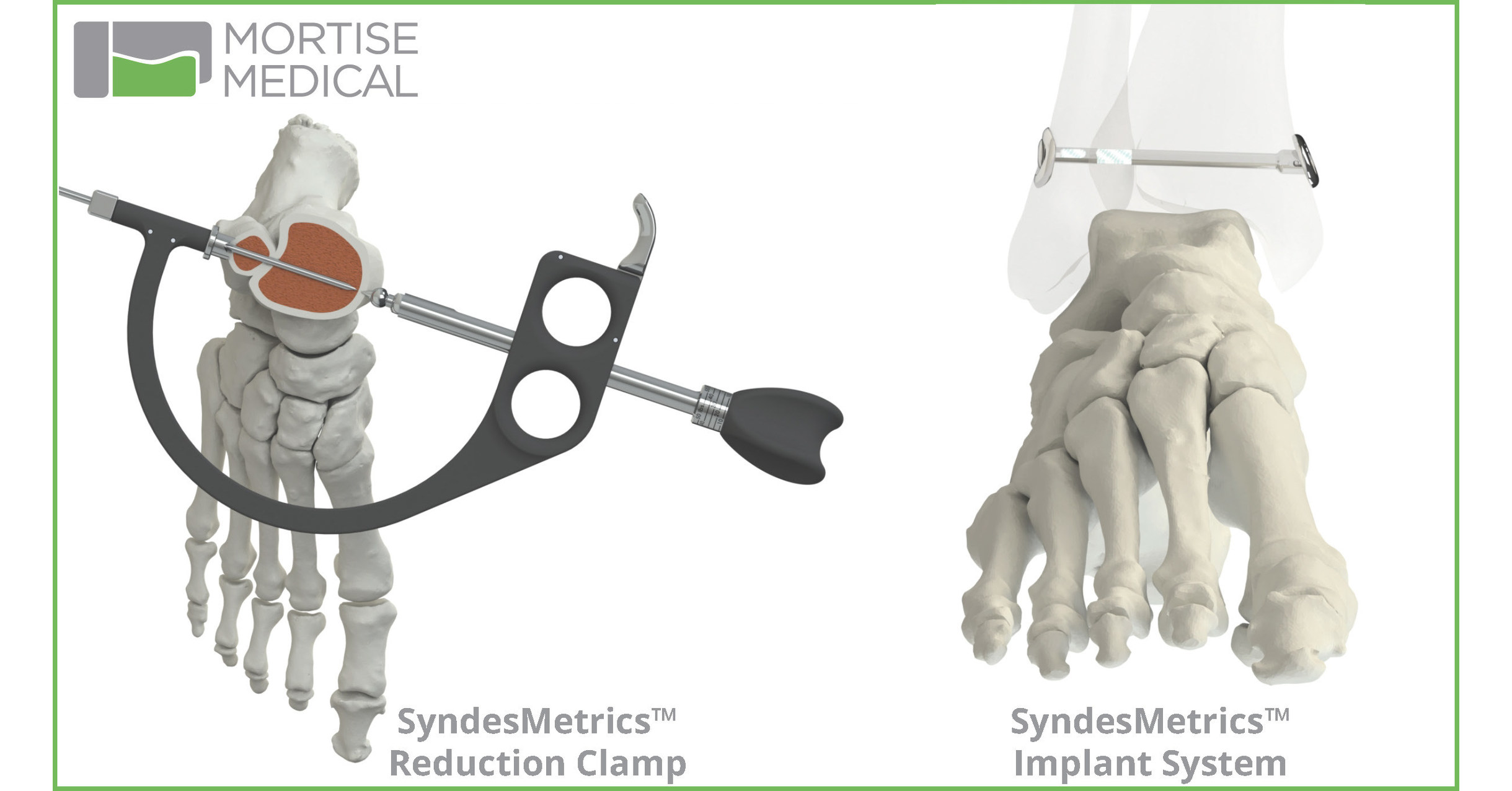 Mortise Medical Receives FDA Clearance for SyndesMetrics™ Syndesmosis