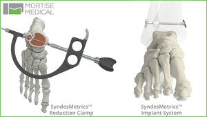 Mortise Medical Receives FDA Clearance for SyndesMetrics™ Syndesmosis Repair System