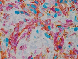 Roche launches DISCOVERY Teal HRP chromogen detection kit to advance tissue-based cancer research