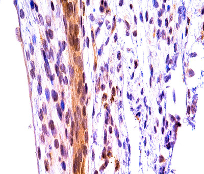 This image shows a section of obstructed extrahepatic bile duct in a neonatal mice that exhibits residual expression of the enzyme called MMP-7 (shown in brown). Researchers report Nov. 22 in Science Translational Medicine that MMP-7 is a strong biomarker candidate for early diagnosis of biliary atresia, the most common cause of liver transplants for children in the United States. This could lead to earlier lifesaving treatments and possibly avoid more invasive procedures like liver transplant.