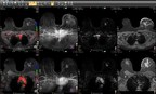 Philips unveils IntelliSpace Portal 10 with new 3D modeling application to enhance diagnostic confidence
