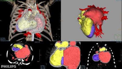 IntelliSpace Portal 10 features an embedded 3D modeling application.