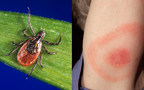 Next generation Lyme disease tests found efficacious and ready for clinical arena