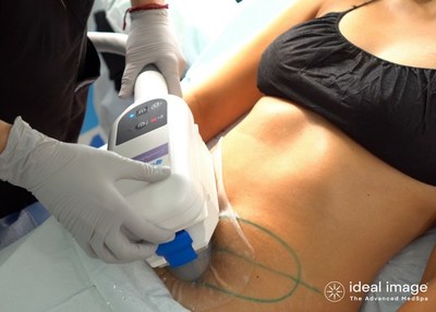 CoolSculpting treatment being performed by a licensed medical professional at Ideal Image, The Advanced MedSpa
