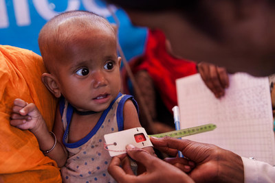 La mesure de la circonfrence du bras de Minara, 10 mois, indique qu'il souffre de malnutrition svre aigu, dans un centre thrapeutique provisoire du camp de fortune de Balukhali, dans le district de Cox's Bazar, au Bangladesh, le 4 dcembre 2017.  UNICEF/UN0151416/Brown (Groupe CNW/UNICEF Canada)