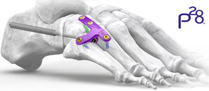 Paragon 28® launches the Gorilla® Lateral Column Plating System - the first dedicated plating system designed to address the cuboid and lateral column in cases of Charcot deformity