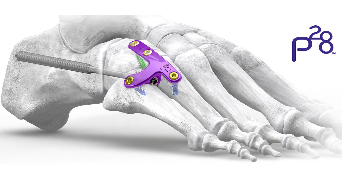 Paragon 28® launches the Gorilla® Lateral Column Plating System the first dedicated plating