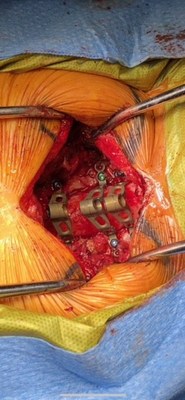 First ever Lamina Replacement performed by Dr. Graham Mouw of Robotics Outpatient Center, Los Angeles, CA:  ROC - LA.