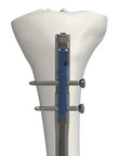 OrthoXel Announce FDA 510k and CE Mark Approval for their Orthopaedic Trauma Product the Apex Tibial Nail System