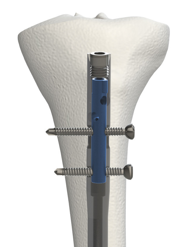 OrthoXel Announce FDA 510k and CE Mark Approval for their Orthopaedic ...