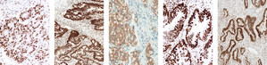 Roche launches CE-marked VENTANA MMR IHC Panel for patients diagnosed with colorectal cancer