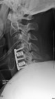 Camber Spine Technologies Announces First Implantations Of SPIRA™-C Open Matrix Cervical Interbody