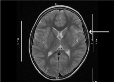 Head imaging (MRI) at 7 years of age. Depression of the brain during birth (Arrow) due to large head circumference (> 90th centile) and narrow birth canal (cephalo-pelvic disproportion) (Jensen and Hamelmann 2016, http://dx.doi.org/10.1155/2016/1717426) (PRNewsfoto/Ruhr-University Bochum, Germany)