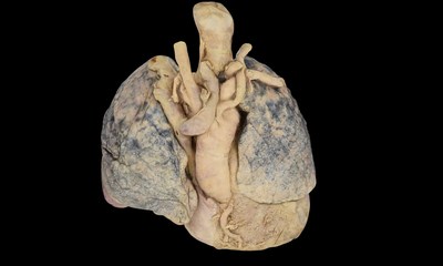 A prosection case of the heart and lungs that will be available on the Anatomage Table.