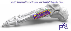 Paragon 28® launches the industry's most robust screw and instrumentation system for addressing Charcot arthropathy - Joust™ Beaming Screw System