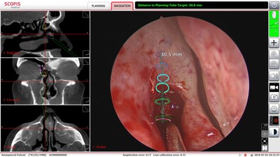 UTHealth sinus surgeons affiliated with Memorial Hermann-Texas Medical Center are the first in the U.S. to use augmented reality technology in minimally invasive sinus surgeries, allowing them to better navigate complex anatomy. (Photo courtesy M. Citardi)