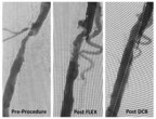 VentureMed Group's FLEX Scoring Catheter® was Featured in a Successful Live Case at ISET 2018