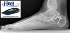 Introducing Heel Defender™ Orthotic Shoe Inserts