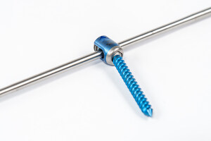 Spinal Resources, Inc.® Announces First Implantation with Swedge™ Pedicle Screw System