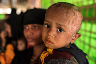 Muhammad Shafiq, jeune rfugi rohingya g de 2 ans, a t svrement brul lorsque les militaires ont mis feu  sa maison au Myanmar. Dans les bras de sa mre Sasaida, ge de 20 ans, il attend d'tre vu par le personnel d'une clinique de nutrition soutenue par l'UNICEF, dans le camp de fortune de Balukhali,  Cox's Bazar, au Bangladesh (11 janvier 2018).  UNICEF/UN0160393/Nybo (Groupe CNW/UNICEF Canada)