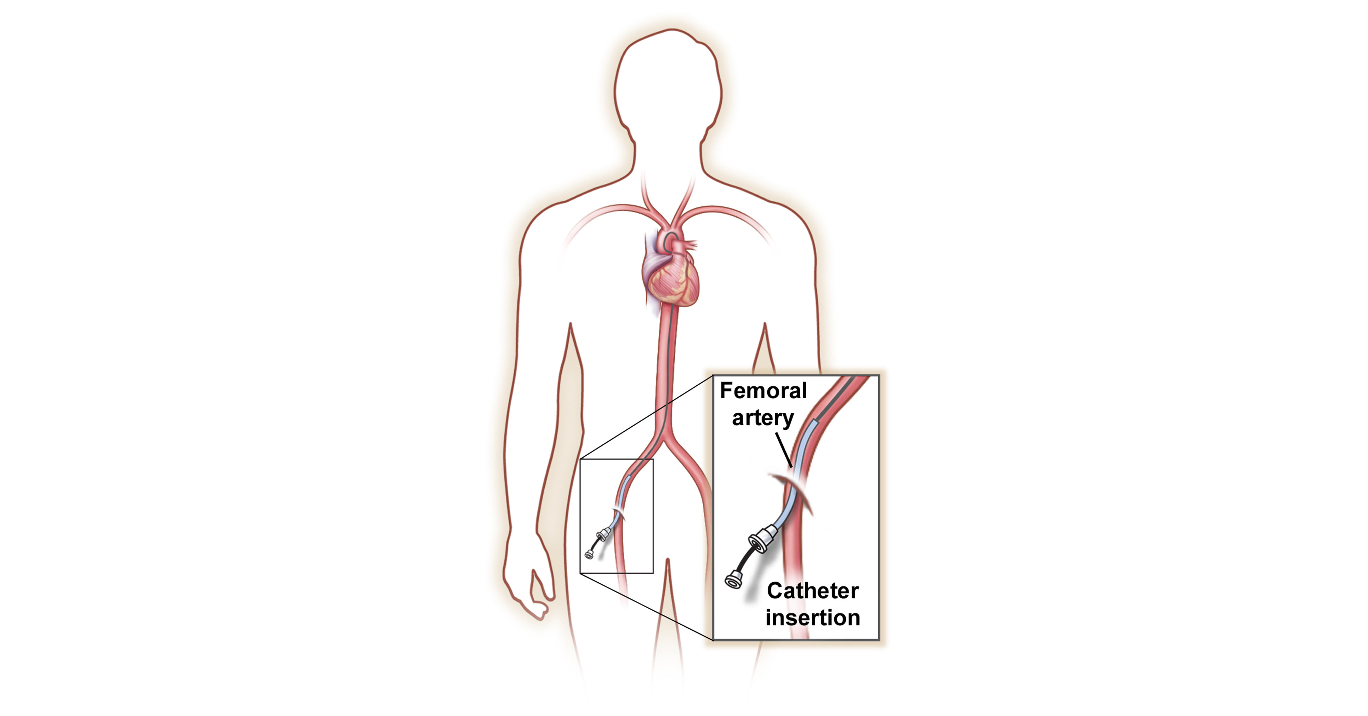 Angiograms and Angioplasty - Using your body's vascular highway to ...