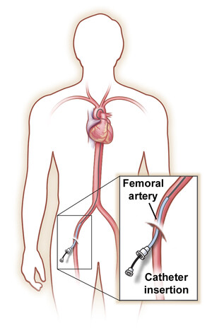 Angiograms and Angioplasty - Using your body's vascular highway to identify and treat blockages