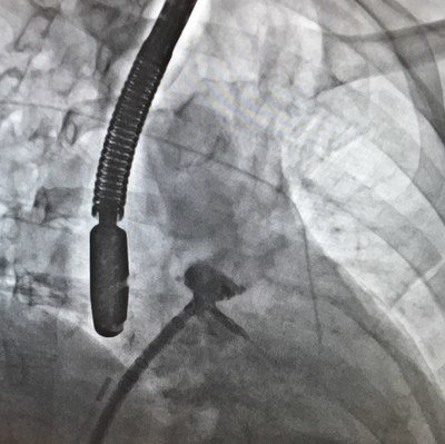 A monitor shows a WATCHMAN Implant procedure at Houston Methodist The Woodlands Hospital.