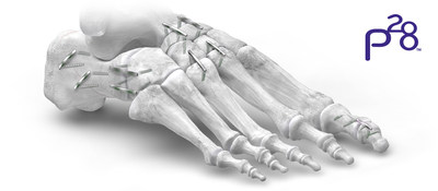 JAWS Nitinol Staple System - Coverage Forefoot to Hindfoot