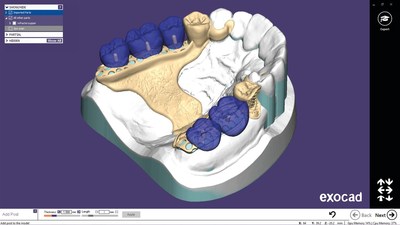PartialCAD pour la conception de prothses dentaires partielles (PRNewsfoto/exocad GmbH)