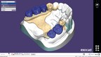 exocad lance PartialCAD pour la conception de prothèses dentaires partielles