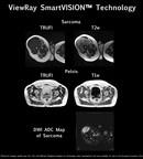 ViewRay Unveils New Soft Tissue Visualization Technologies to Further Advance MR Image-Guided Radiotherapy