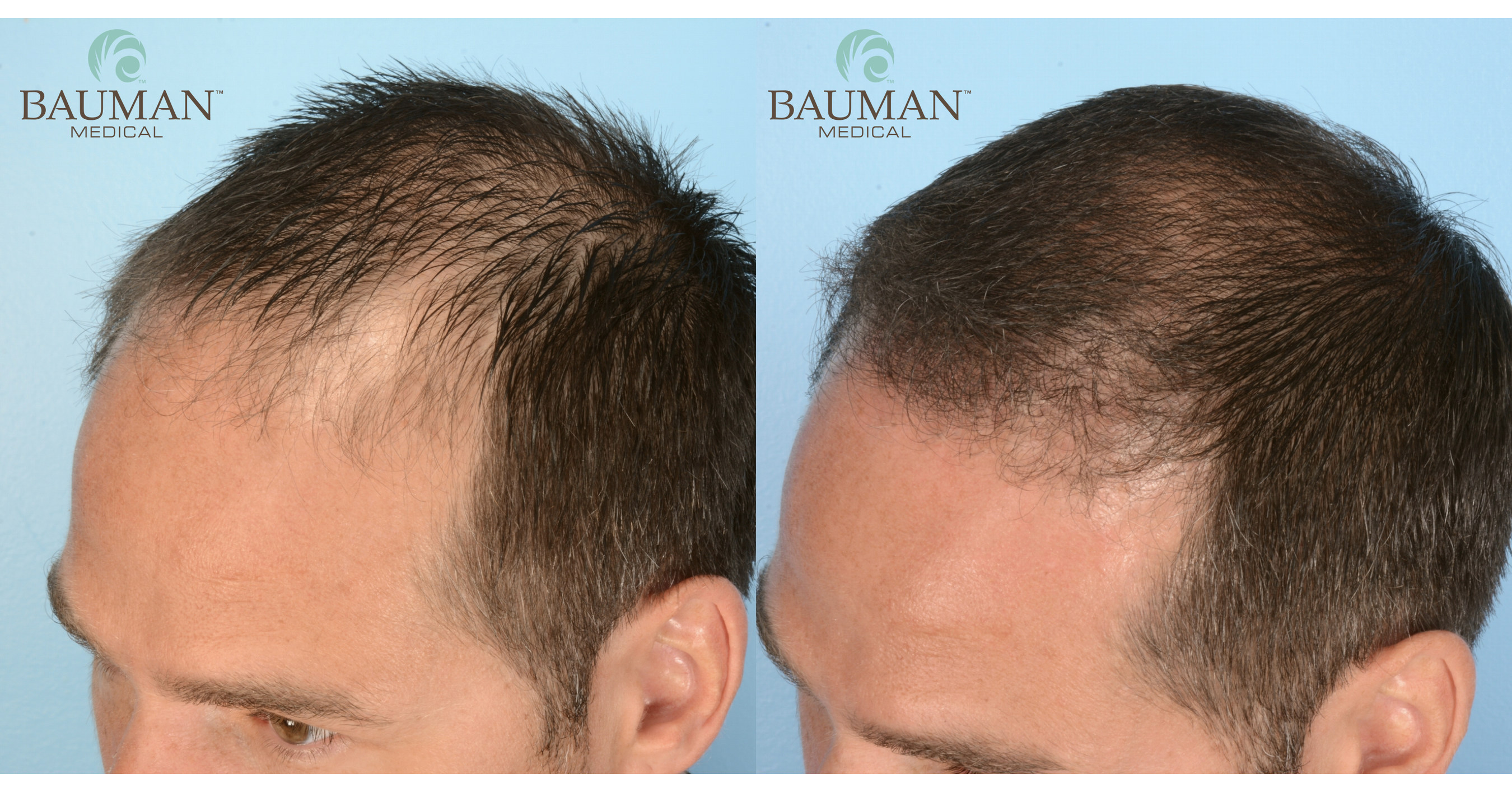 Alan Bauman, MD, Adds SmartGraft® To Treatment Portfolio, Producing  Natural-Looking Hair Transplant Results From His Florida Practice