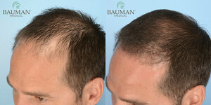 Alan Bauman, MD, Adds SmartGraft® To Treatment Portfolio, Producing Natural-Looking Hair Transplant Results From His Florida Practice