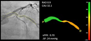 L'étude FAST fait la preuve de la haute précision diagnostique du CAAS vFFR qui obtient le feu vert 510(k) de la FDA pour sa mise sur le marché.