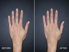 Nestlé Skin Health Announces the FDA Approval of Restylane® Lyft for Hands, the First and Only Hyaluronic Acid (HA) Dermal Filler for Use in the Back of Hands
