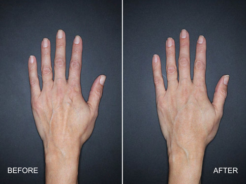 Actual user*. Individual results may vary. Treated with 3mL of Restylane Lyft in the left hand. 4 weeks after treatment. *user = clinical trial subject
